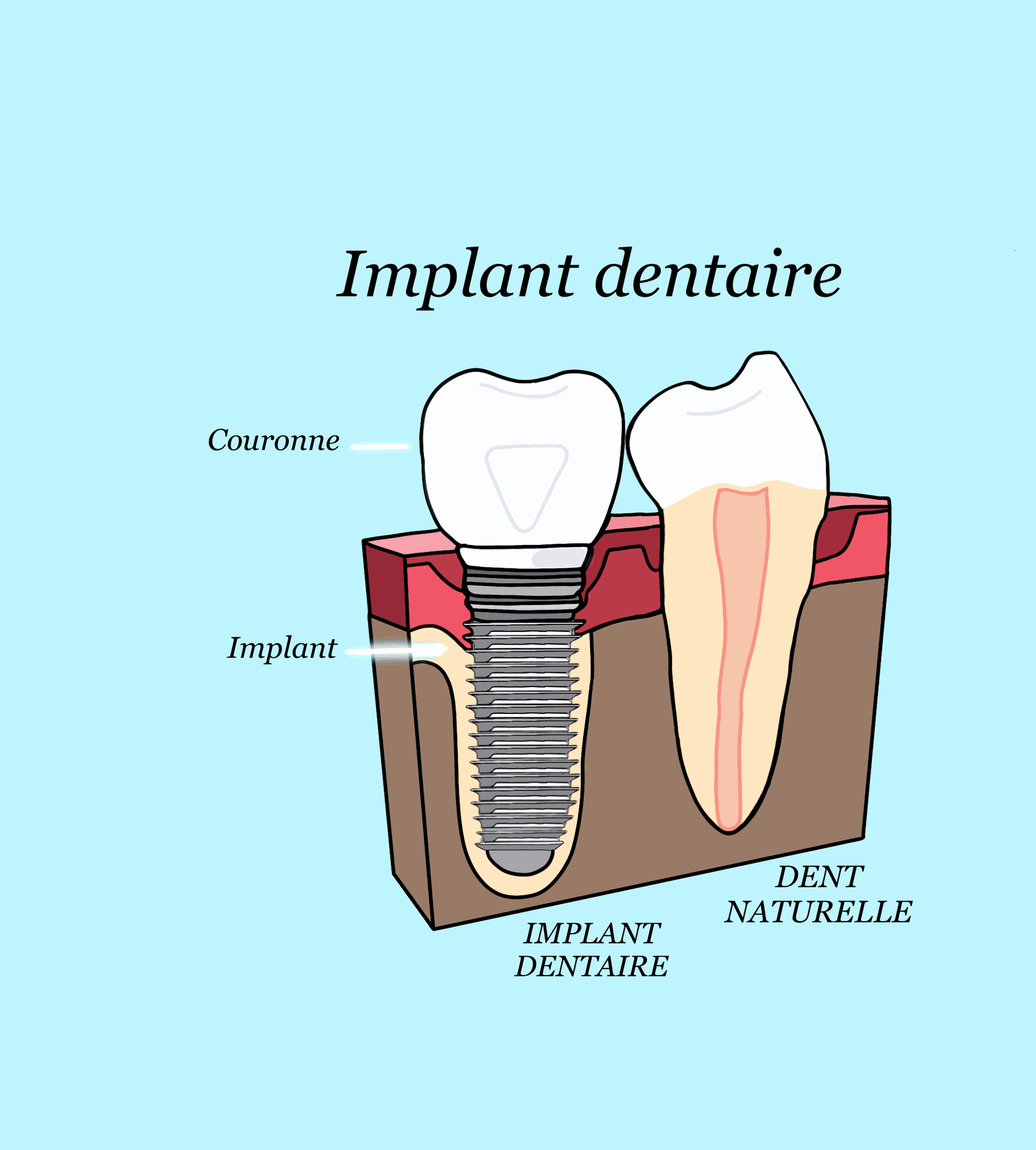Implant dentaire